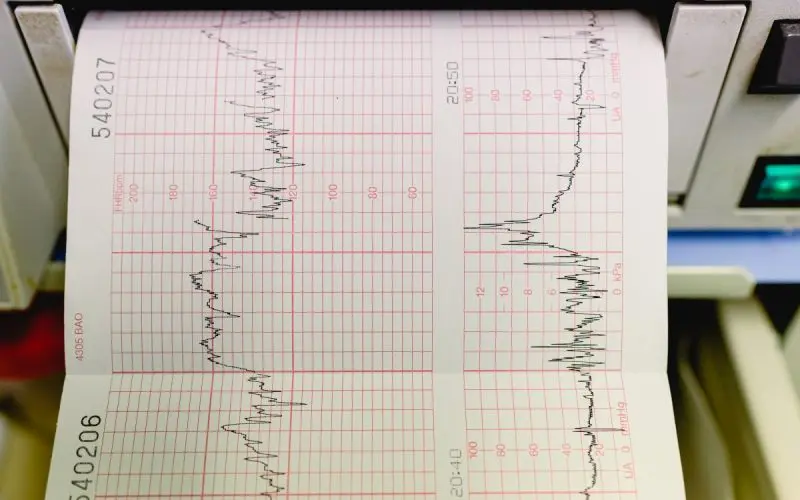 ECG Tracings