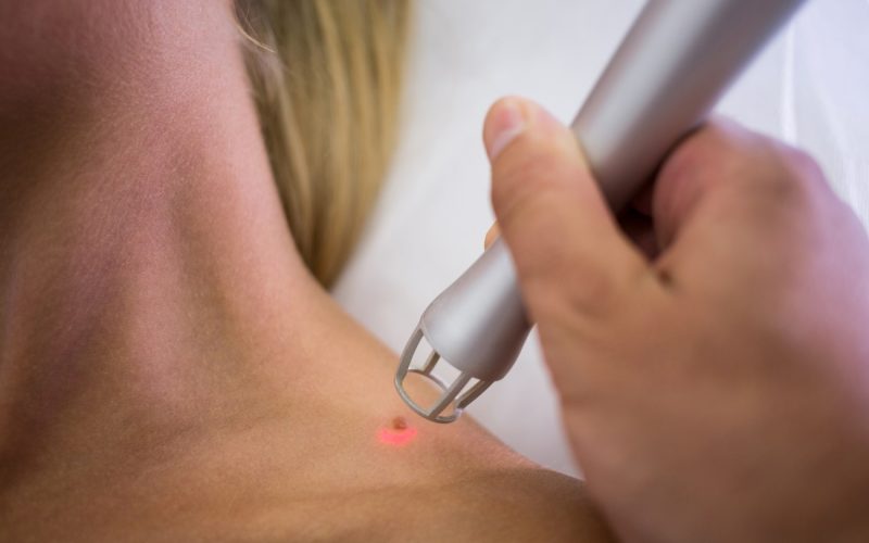 Doctor performing dermoscopy skin examination at Botanic Ridge Doctors